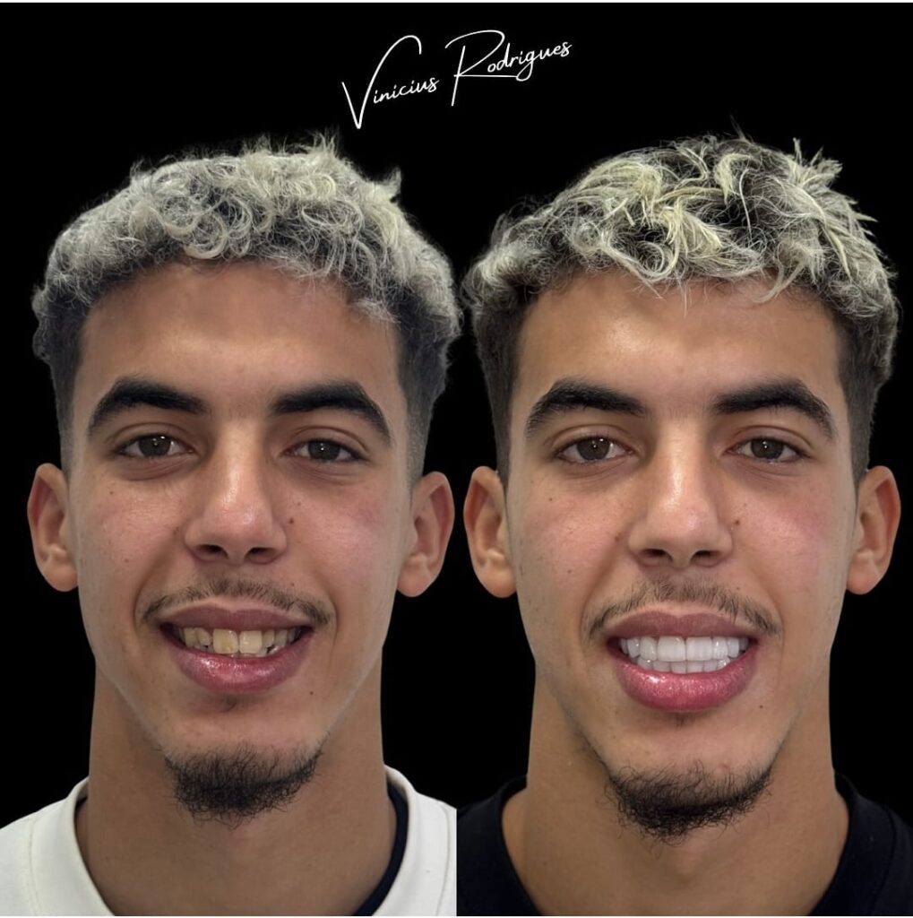 ياسر الزبيري يشعل منصات التواصل بابتسامته الجديدة بعد عملية تجميل الأسنان