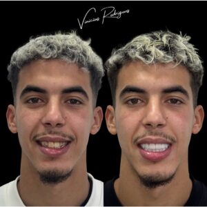 ياسر الزبيري يشعل منصات التواصل بابتسامته الجديدة بعد عملية تجميل الأسنان